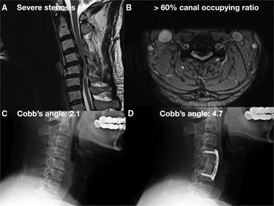 The surgical strategy for multilevel massive ossification of the posterior longitudinal ligaments